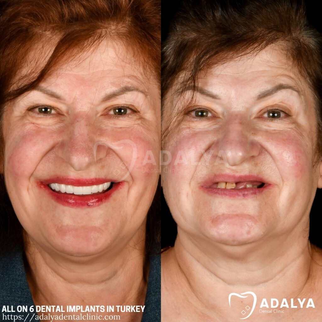 Adalya Dental Clinic - published treatment example 1