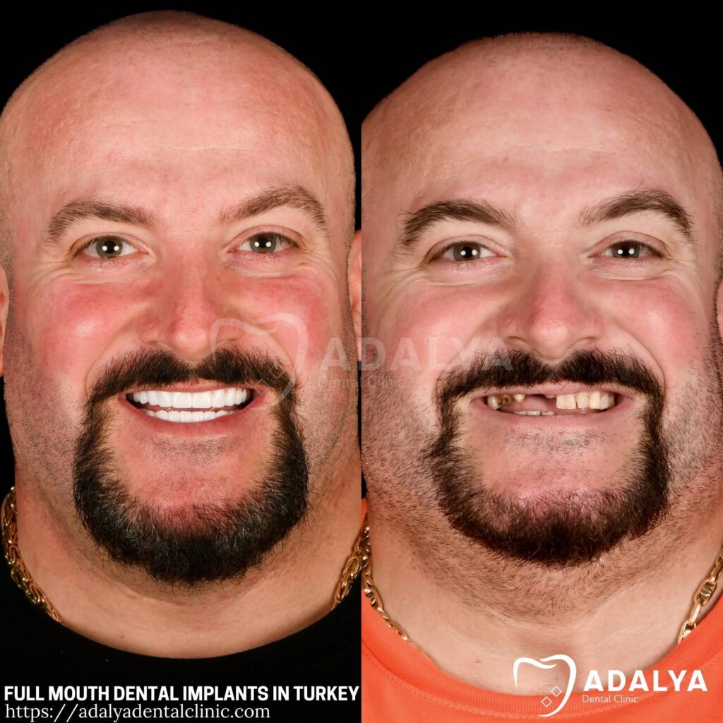 Adalya Dental Clinic - published treatment example 2
