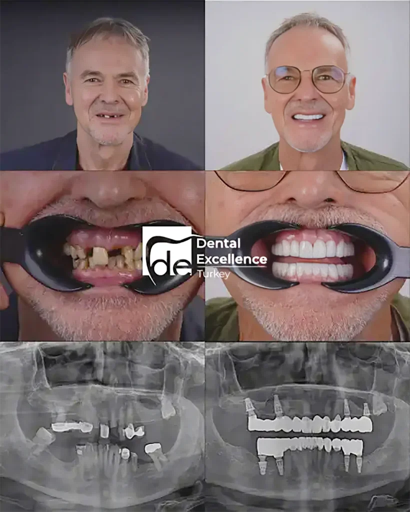 Dental Excellence Turkey treatment example 1