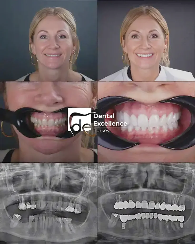 Dental Excellence Turkey treatment example 2