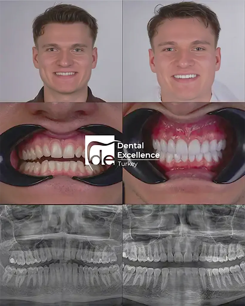 Dental Excellence Turkey treatment example 3