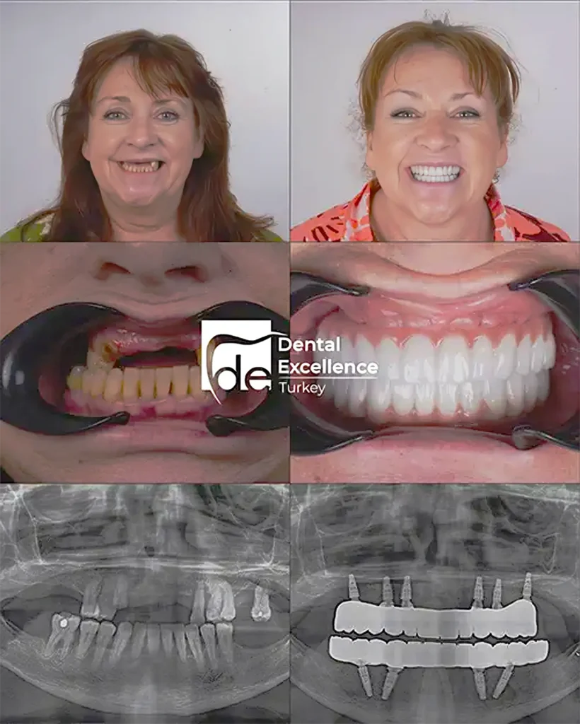 Dental Excellence Turkey treatment example 4